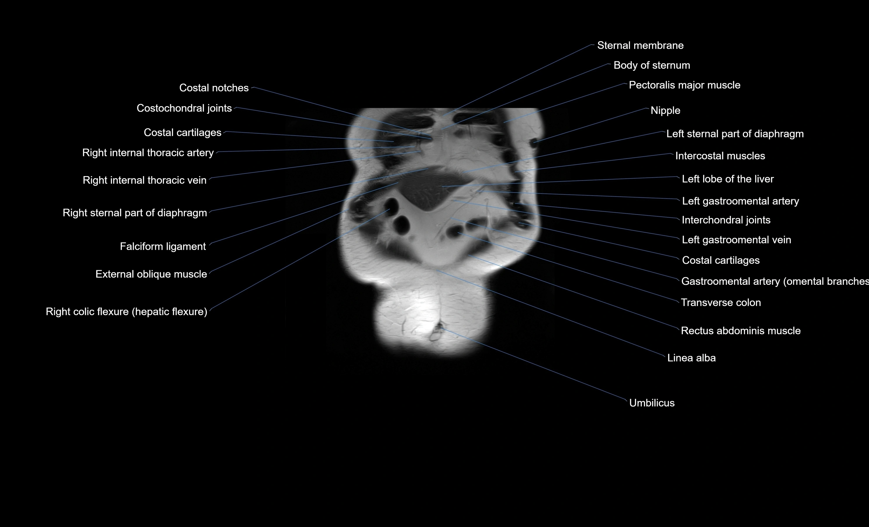 MRI Abdomen coronal labelled cross sectional anatomy radiology  image-img-00001-00008.webp